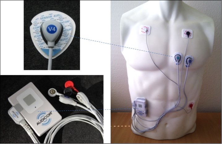 Acoustic cardiography monitoring device, sensor and placement on torso