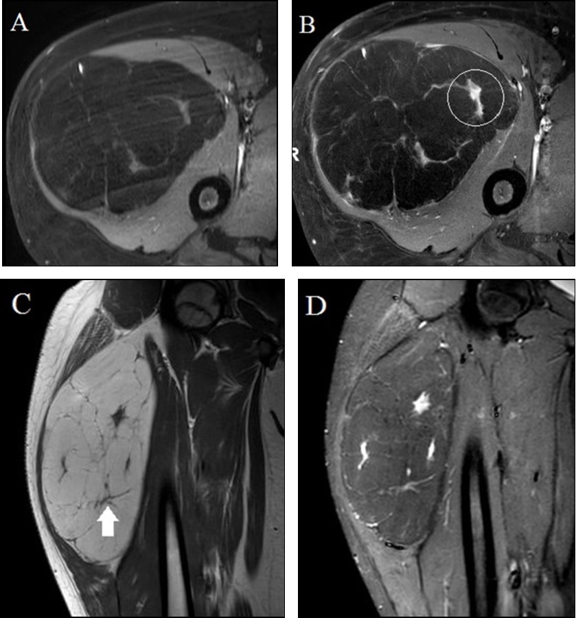 13 year old male with a fatty proximal right thigh mass. A-B. Axial unenhanced (A) and gadolinium-enhanced (B) fat-suppressed T1-weighted turbo spin echo images demonstrate an anterior compartmental mass largely demonstrating similar signal intensity to subcutaneous fat with internal enhancing nodularity (circle in B). C-D. Coronal T1-weighted turbo spin echo (C) and short tau inversion recovery (D) images demonstrate internal thin internal septations (arrow in C) and internal nodularity with increased STIR signal intensity.