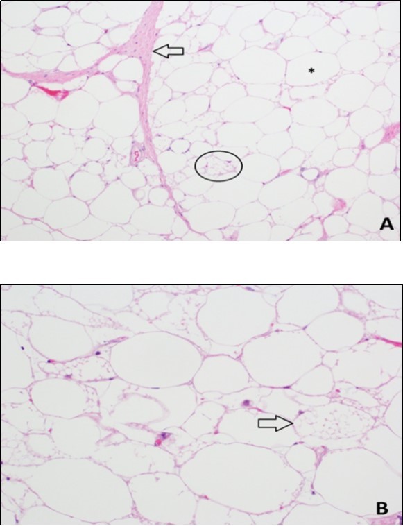Histopathology of lipomatous mass. A. Hematoxylin and eosin stain (10X) demonstrates fibrous septae (arrow), mature white adipocytes (*), and multivacuolated brown fat cells (circle). B. Hematoxylin and eosin stain (20X) demonstrates several multivacuolated brown fat cells (arrow) with granular eosinophilic cytoplasm.