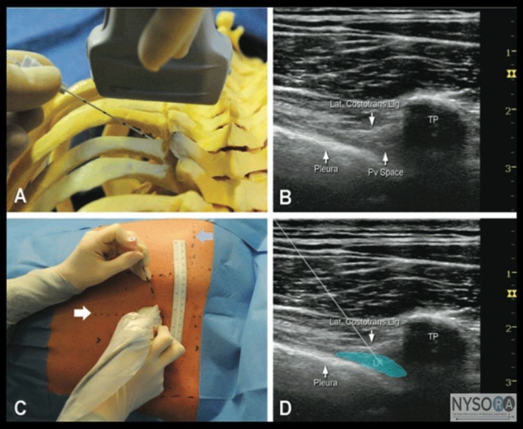 U/S guided Thoracic epidural and paravertebral blocks 43