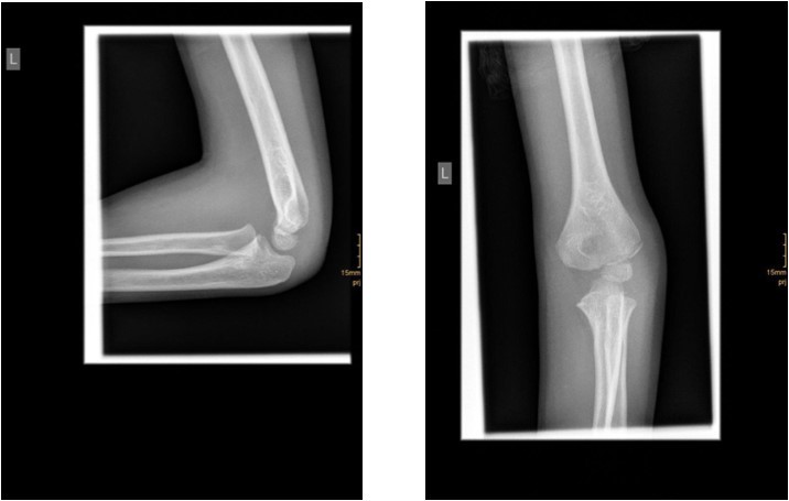 6 year old male patient with a undislocated left lateral condyle fracture which was succesfully treated with a cast (personal collection)