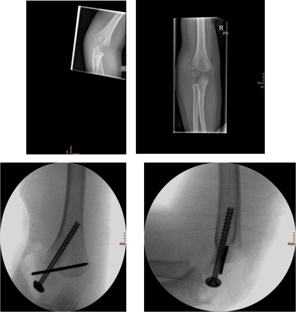 6 year old male patient with a dislocated right lateral condyle fracture which was treated by open reduction and osteosynthesis with a screw and a Kirschner wire (personal collection)