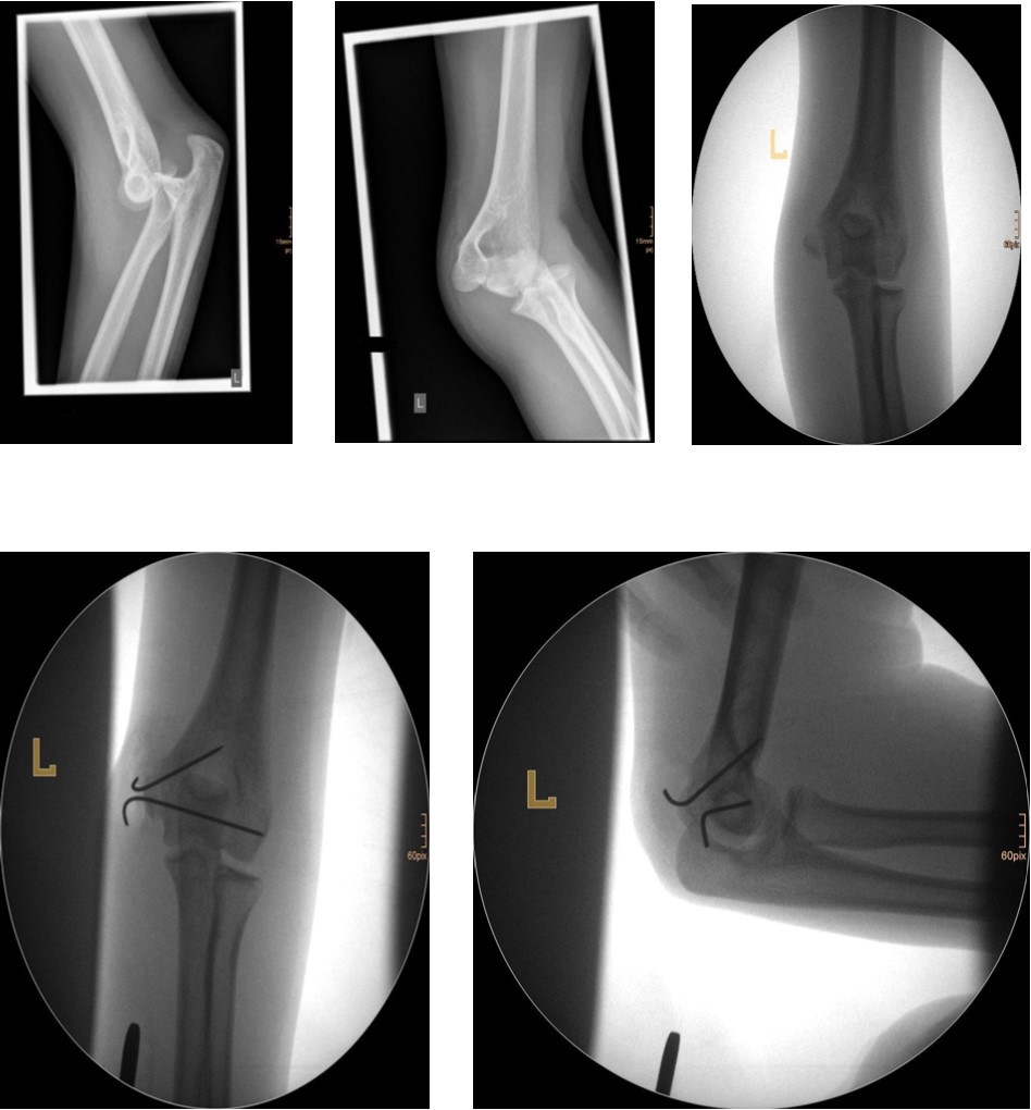 14 year old female patient with a elbow dislocation and a dislocated left epicondyle                 fracture which was treated by open reduction and osteosynthesis with two divergent Kirschner wires (personal collection)