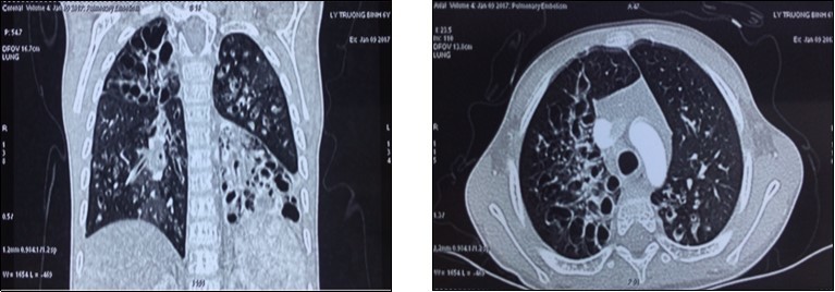 The chest CT-scan image of receipient (difuse bronchiectasis)