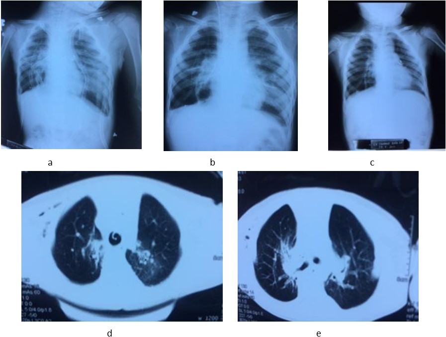 The chest X-ray images at the first (a), 7th day (b) and 12th month (c). CT-scan images at the 3th day (d) and 8th day (e) after lung transplantation.