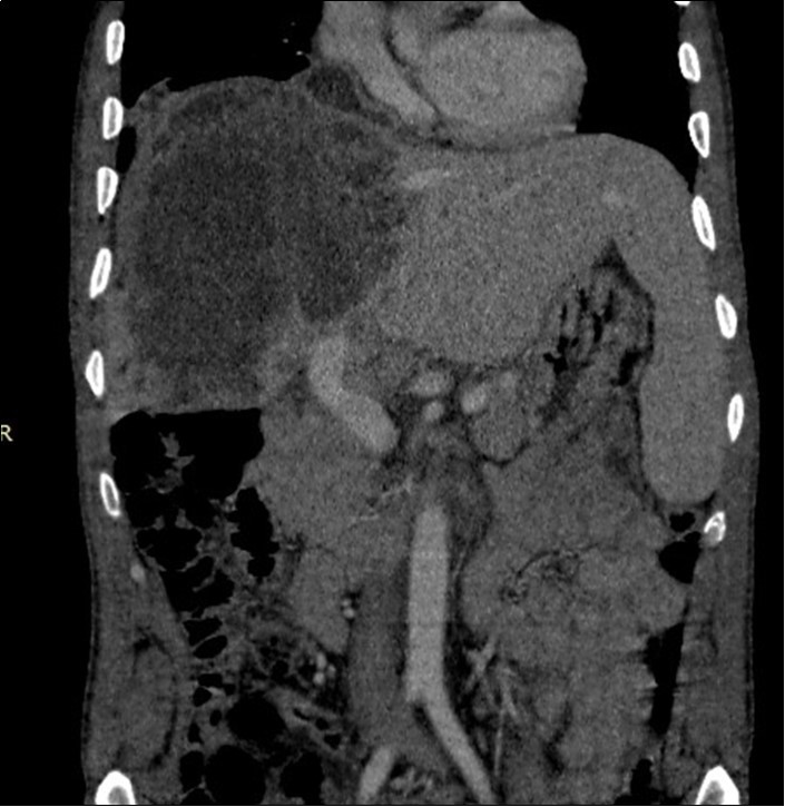 Coronal CT scan showing the hypodense heterogeneous liver mass in contact with the portal vein and diaphragm