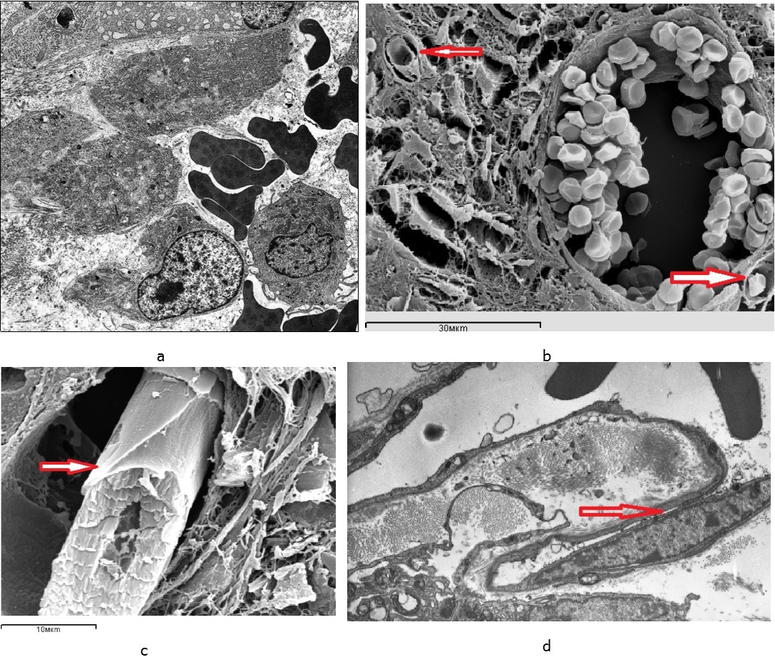 Blood vessels in the intermediate zone of regenerated bones 7 days after fracture occurrence: а – a sinusoid in the regenerated bone in the animal from the control group; b, c, d – newly formed capillary terminals (arrows) in the regenerated bone in the animals from the experimental group – 3 sessions of laser therapy; а, b, c – scanning electron microscopy, d – an ultrathin section, transmission electron microscopy, magnification x 8000.