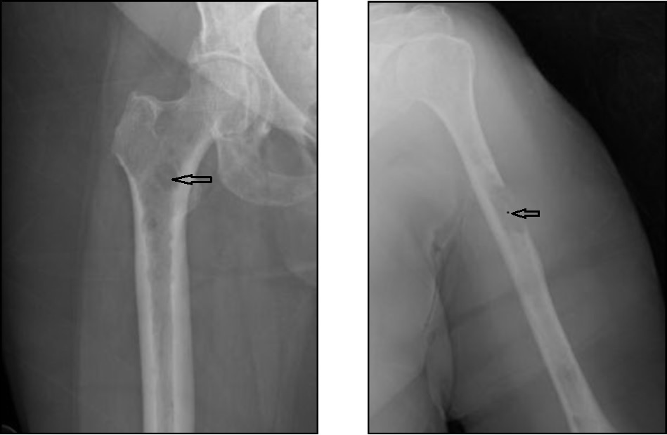 A Multiple focal and diffuse small lucencies throughout the right upper femurs (most prominent marked with an arrow). Figure 1. B Multiple lucencies throughout left humerus with a destructive large lesion in the upper third region.