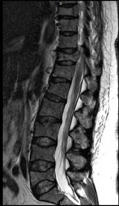 Several pathologic compression and burst fractures throughout the spine. Ventral cord indentation at T1, T8 and T11. Rostrocaudal cord edema spanning T10-T12 secondary to more significant cord compression. Bulky left paraspinal osseous/extraosseous disease at T8 (arrow) causing potential impingement.