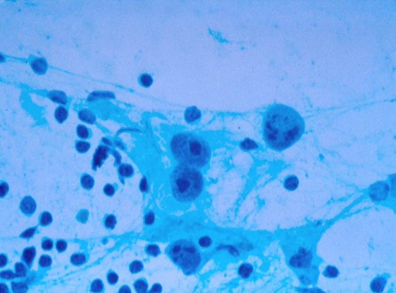 Positive, Hodgkin’s Lymphoma, Reed Sternberg cell, Center (Papanicolaou stain 50x).
