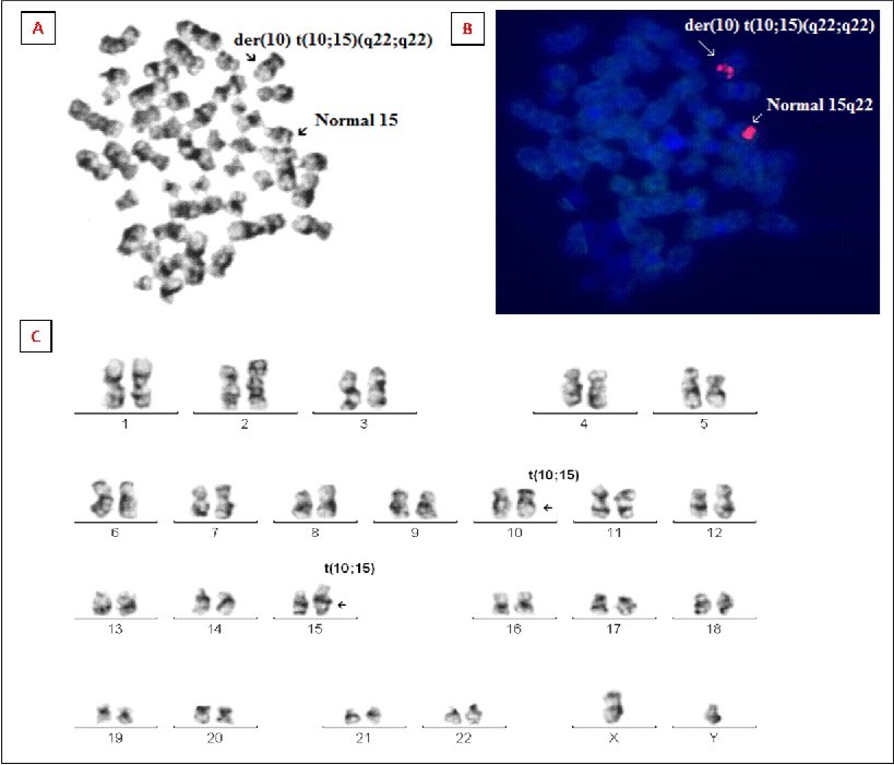 (A) Image of a GTG-banded bone marrow metaphase before FISH analysis. (B) Bone marrow metaphase FISH analysis using a LSI probe (red), revealing localization of one red signal on the derivative chromosome 10q22 and other on the normal 15 chromosome (15q22).            (C) Representative karyogram of bone marrow cell showing novel translocations t(10;15)(q22;q22).