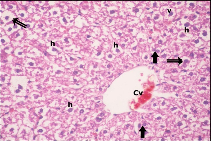 A photomicrograph of a section in the liver of ZnONPs-treated adult albino rat showing dilated congested central vein (Cv) and ballooning of hepatocytes (double arrows) with darkly-stained nuclei (h) and vacuolated  cytoplasm (v). Binucleated cells are also seen (thick arrows). (H&E  X400)
