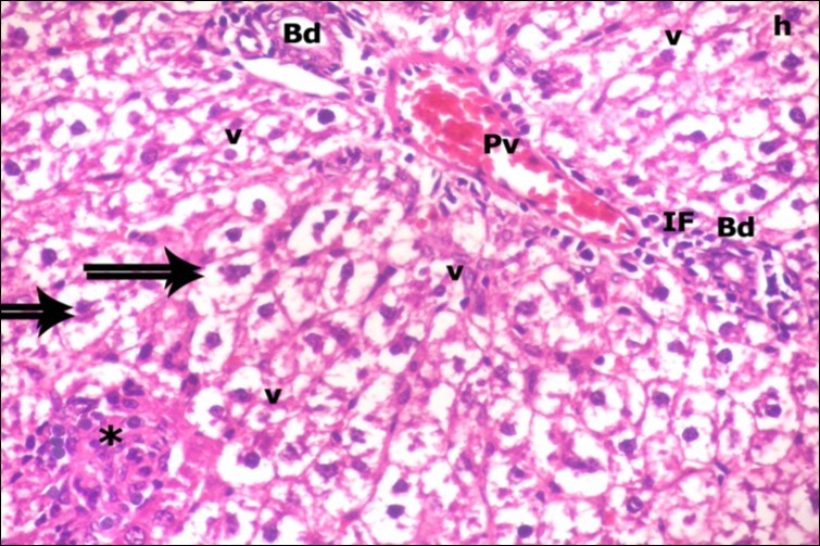 A photomicrograph of a section in the liver of ZnONPs-treated adult albino rat showing dilated congested portal vein (Pv), proliferation of bile duct (Bd), inflammatory cell infiltration (IF) and ballooning of hepatocytes                           (double arrows) with darkly-stained nuclei (h) and vacuolated cytoplasm (v). Area of necrotic focus is also present (star). (H&E  X400)