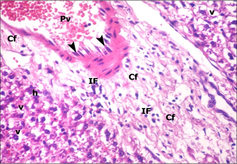 A photomicrograph of a section in the liver of ZnONPs-treated adult albino rat showing congested portal vein (Pv) with elongation of its endothelial lining                    (arrow head) and increasing amount of connective tissue fibers (Cf). Mononuclear cellular infiltration (IF) and hepatocytes with darkly-stained nuclei (h) and                    vacuolated cytoplasm (v) could be demonstrated. (H&E  X400)