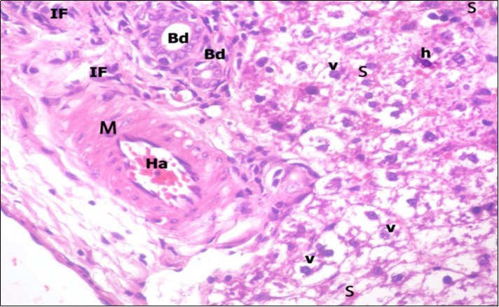 A photomicrograph of a section in the liver of ZnONPs-treated adult albino rat showing congested hepatic artery (Ha) with increasing thickness of its muscular layer (M) and proliferation of bile duct (Bd).                     Mononuclear cellular infiltration (IF), congested blood sinusoids (s) and hepatocytes with darkly-stained nuclei (h) and vacuolated cytoplasm (v) are also seen. (H&E  X400)