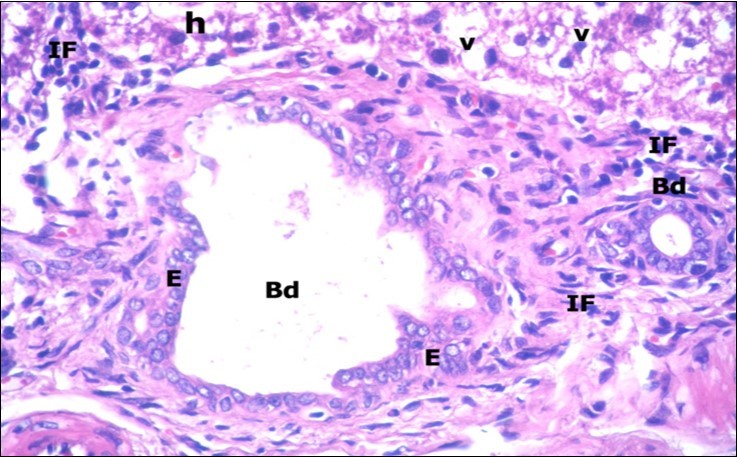 A photomicrograph of a section in the liver of ZnONPs-treated adult albino rat showing proliferation of bile duct (Bd) with stratification of its      epithelial lining (E). Mononuclear cellular infiltration (IF) in the portal area and hepatocytes with darkly-stained nuclei (h) and vacuolated cytoplasm (v) are also seen. (H&E  X400)