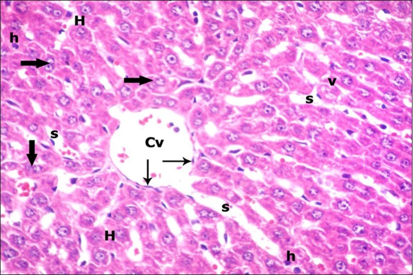 A photomicrograph of a section in the liver of ZnONPs & VE- treated adult                   albino rat showing slightly dilated sinusoids (s) and central vein (Cv) with flat                       endothelial lining (thin arrows). Most of hepatocytes are with vesicular nuclei and                  acidophilic cytoplasm (H). Others show darkly-stained nuclei (h) and less vacuolated cytoplasm (v). Binucleated cells (thick arrows) are also seen. (H&E  X400)