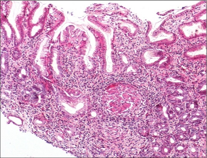 Histological aspect of gastric granulomatosis secondary to             tuberculosis : Antral biopsy specimens revealing multiple necrotizing (caseating) granulomas ( HEx100)
