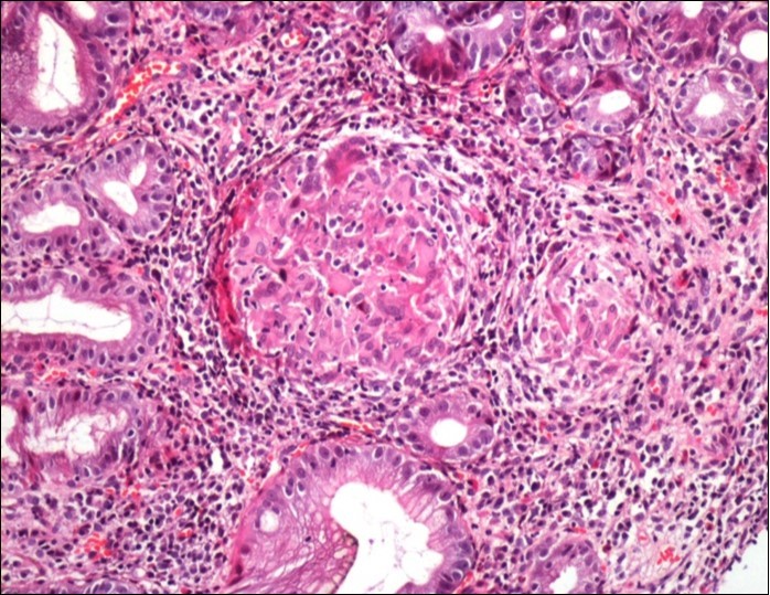 Histological aspect of gastric granulomatosis secondary to             sarcoidosis : Antral biopsy specimens revealing multiple non-necrotizing (sarcoid-like) granulomas ( HEx200)