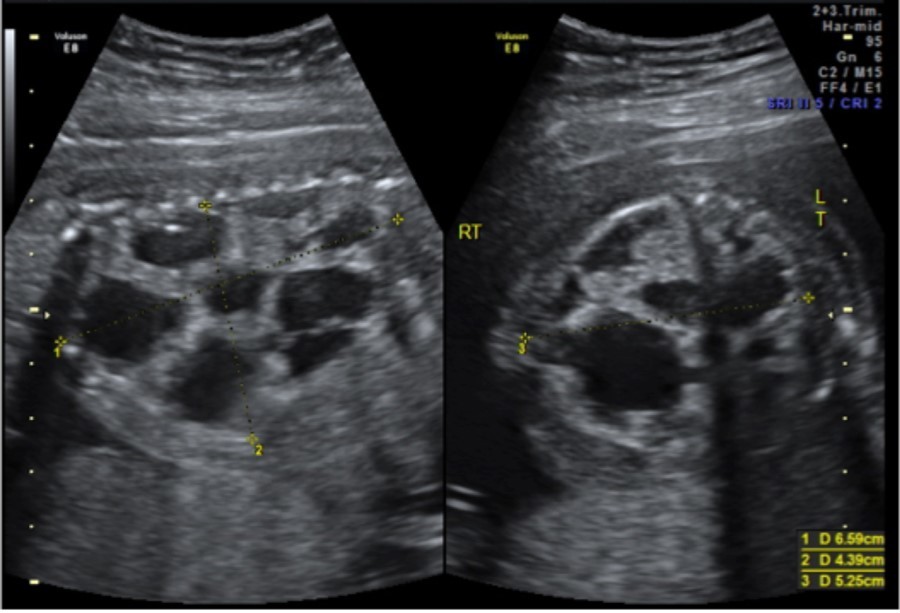 CPAM noted at initial fetal surgery consultation; sagittal view on the left and                 transverse view on the right