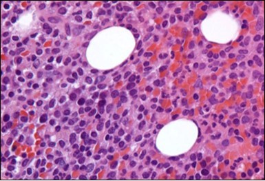 HCL: hairy cells infiltrating             designated spaces(17).