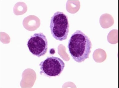 HCL: inconspicuous nucleoli, open-ended chromatic and surface               protrusions(26).