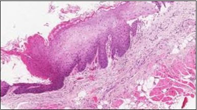 HCL Oral mucosa with soft tissue  infiltration of hairy cells(27).