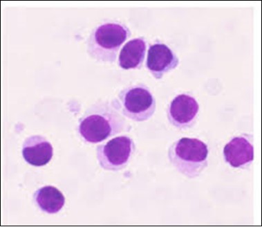 HCL: hairy cells with broad and fine projections of the                             cytoplasm(28).