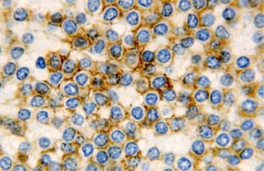 HCL: hairy cells immune              reactive for  CD 11c(24).