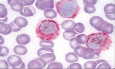 HCL: hairy cells with                            demonstrable  tartrate resistant acidic         phosphatise( TRAP) stain(29).