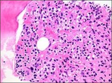 HCL: hairy cells with                        projecting cytoplasm abutting bony trabaculae(18).