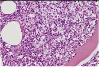 HCL: hairy cells with widely spaced nuclei(20).