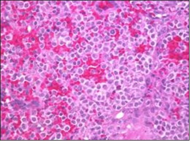 HCL: hairy cells with                               infiltration in the spleen(21).