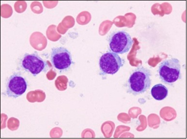 HCL: blebs on the cellular surface with fine nuclear  chromatin(23).