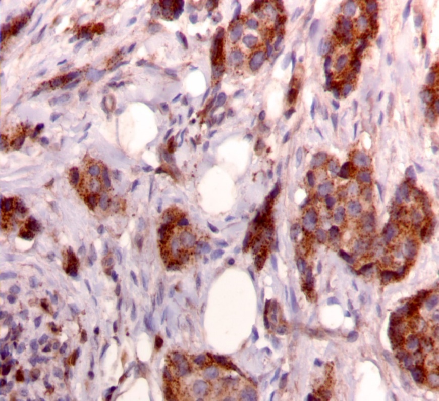 Punctate cytoplasmic staining pattern for IRS-2. (IRS-2 immunohistochemical stain, 200x magnification)