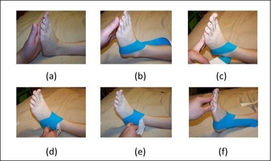 Neuromuscular taping technique. (a) initial position, (b) non-tension taping, (c) tension taping, (d) Aquile´s heel part, (e) non tension plantar taping and (f) final taping.