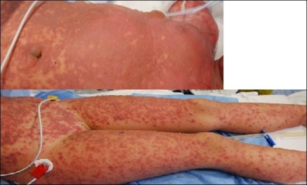 Emergency care of Lyell onset.  Skin lesions were  involving 100% TBSA. Here we see the typical aspect at trunk and arms level.