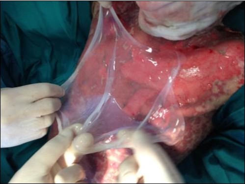 Application of  Amniotic Membrane (AM)  on chest level after surgical debridement.