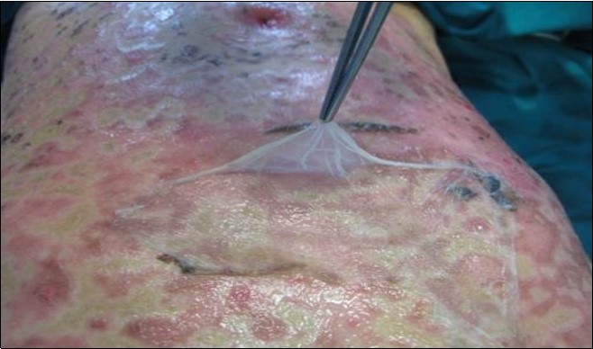 Aspect of  Amniotic Membrane at 7 day after surgery with skin healing. A part of AM was retain  for histological consideration.