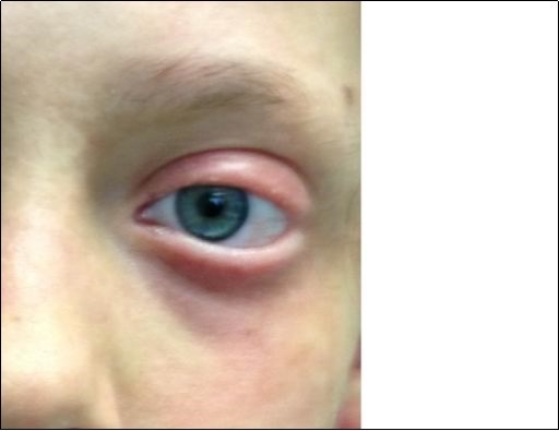 Particular of the complete eye mucosal healing without damage.