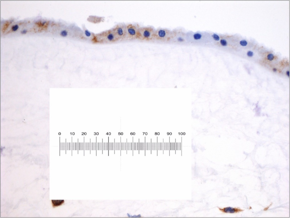 Immunochemistry findings on a native Amniotic                   Membrane retain before application on damaged skin. It’s possible to evaluate its structure with  double layer with avascular stroma . The blue marked cell are positively to CD34+ stain as                 hematopoietic stem cell progenitor. Scale bar 1MM/0.01 mm.