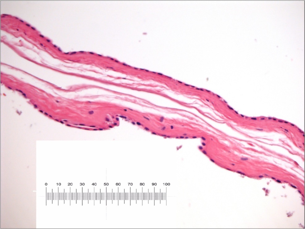 Amniotic Membrane after remove in advanced                          epithelization. Please note conservation of  its cytological pattern :           epithelial layer, thick basement membrane and vascular connective tissue layer. No particular  inflammatory response was evident. Scale bar 1MM/0.01 mm.