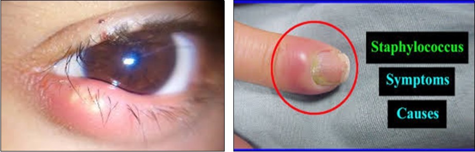 skin disease of Staphylococcus aureus