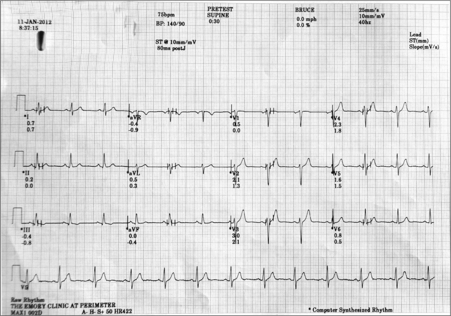 Normal baseline resting electrocardiogram at a heart rate of 75 bpm.