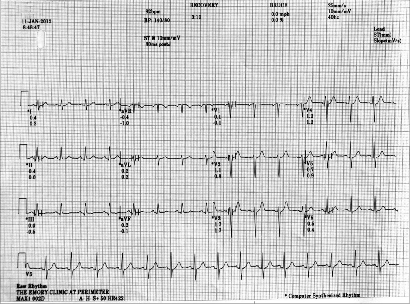 Complete resolution of LBBB occurred only after 3:10 minutes of recovery.