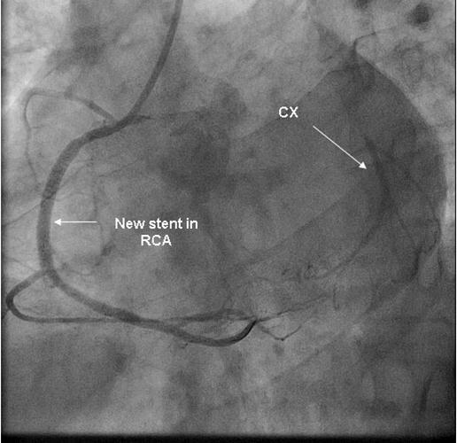 New stent in RCA with retrograde filling of CX