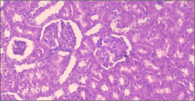 Photomicrogragh of kidney section of obese rat showing fatty degeneration of the tubules with              eosinophilic matrial deposition, glomrerular atrophy with wide urinary space and distal tubules with                 extrusion of nuclei into lumen , (H&E) (40X).