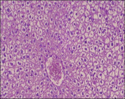 Photomicrograph of liver section of obese rat showing swollen hepatocytes with vacuolated cytoplasm filled  with fatty  infiltration, congested central vein  and disappearance of blood sinusoids, (H&E) (40X).
