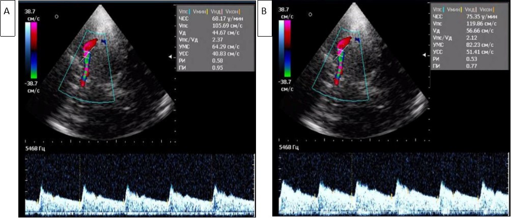 Registration of blood flow in the left (A) and right (B) middle cerebral arteries in triplex mode (A). High and asymmetric Vs (105 cm/s and 119 cm/s) are determined in the middle cerebral arteries.
