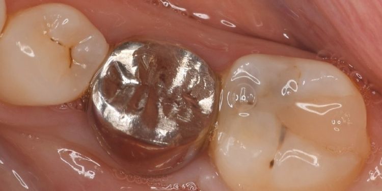Journal of Dentistry And Oral Implants-Auto transplantation